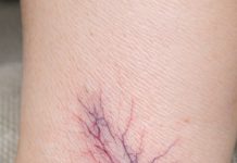 Noticed these purple webs spreading on my wife’s ankles. She says they sting by the end of the day. Dermatologist is booked out for months. Are these dangerous?
