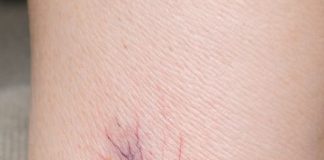 Noticed these purple webs spreading on my wife’s ankles. She says they sting by the end of the day. Dermatologist is booked out for months. Are these dangerous?