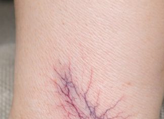 Noticed these purple webs spreading on my wife’s ankles. She says they sting by the end of the day. Dermatologist is booked out for months. Are these dangerous?