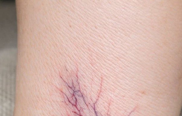 Noticed these purple webs spreading on my wife’s ankles. She says they sting by the end of the day. Dermatologist is booked out for months. Are these dangerous?