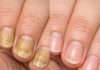 Soak your nails in this 1 mixture and get rid of yellow discoloration, brittle edges, and dull spots