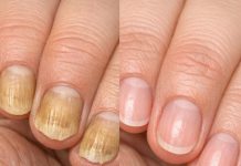 Soak your nails in this 1 mixture and get rid of yellow discoloration, brittle edges, and dull spots