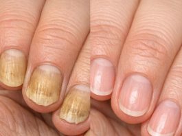 Soak your nails in this 1 mixture and get rid of yellow discoloration, brittle edges, and dull spots