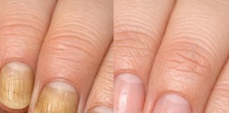 Soak your nails in this 1 mixture and get rid of yellow discoloration, brittle edges, and dull spots