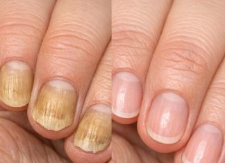 Soak your nails in this 1 mixture and get rid of yellow discoloration, brittle edges, and dull spots