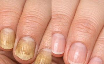 Soak your nails in this 1 mixture and get rid of yellow discoloration, brittle edges, and dull spots