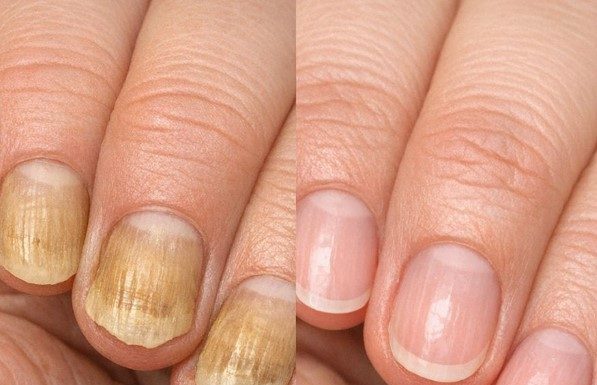 Soak your nails in this 1 mixture and get rid of yellow discoloration, brittle edges, and dull spots