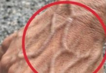 If Someone Has Visible Veins, Does It Mean Their Circulation Is Poor?