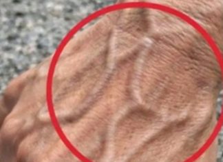 If Someone Has Visible Veins, Does It Mean Their Circulation Is Poor?