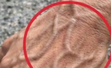 If Someone Has Visible Veins, Does It Mean Their Circulation Is Poor?