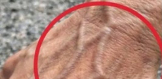 If Someone Has Visible Veins, Does It Mean Their Circulation Is Poor?