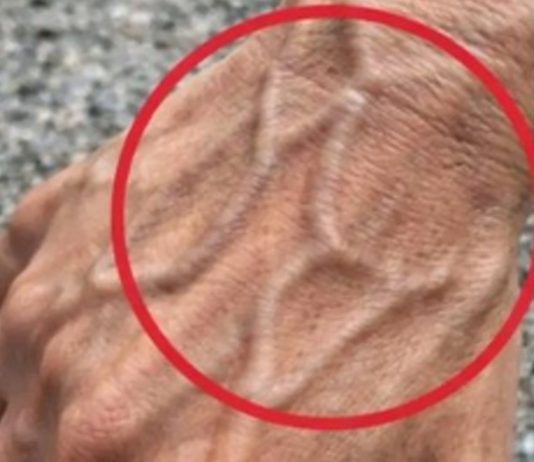 If Someone Has Visible Veins, Does It Mean Their Circulation Is Poor?