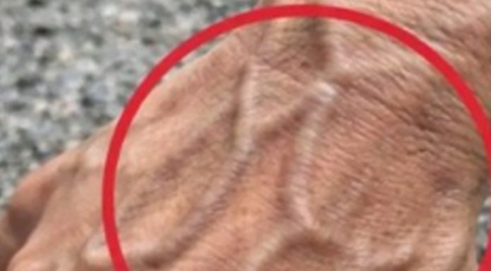 If Someone Has Visible Veins, Does It Mean Their Circulation Is Poor?