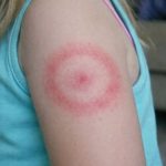 My daughter woke up with this strange red ring on her arm. It’s not itchy but looks spreading. I’m panicking, do I need to rush her in?