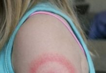 My daughter woke up with this strange red ring on her arm. It’s not itchy but looks spreading. I’m panicking, do I need to rush her in?