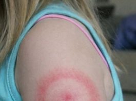 My daughter woke up with this strange red ring on her arm. It’s not itchy but looks spreading. I’m panicking, do I need to rush her in?