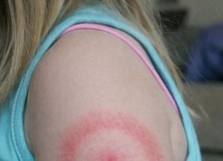 My daughter woke up with this strange red ring on her arm. It’s not itchy but looks spreading. I’m panicking, do I need to rush her in?