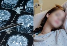 5 Alarming Stroke Warning Signs to Watch for in Young People