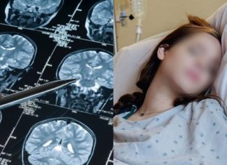 5 Alarming Stroke Warning Signs to Watch for in Young People