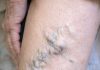 My mom showed me her legs today and the veins look like they are about to burst. She’s in pain but refuses to go to the ER. How can I help her at home?
