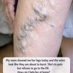 My mom showed me her legs today and the veins look like they are about to burst. She’s in pain but refuses to go to the ER. How can I help her at home?