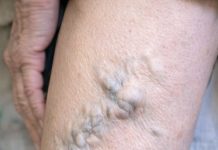 My mom showed me her legs today and the veins look like they are about to burst. She’s in pain but refuses to go to the ER. How can I help her at home?