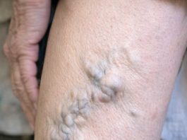 My mom showed me her legs today and the veins look like they are about to burst. She’s in pain but refuses to go to the ER. How can I help her at home?