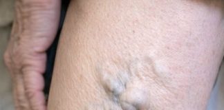 My mom showed me her legs today and the veins look like they are about to burst. She’s in pain but refuses to go to the ER. How can I help her at home?