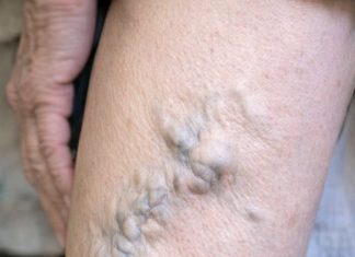 My mom showed me her legs today and the veins look like they are about to burst. She’s in pain but refuses to go to the ER. How can I help her at home?