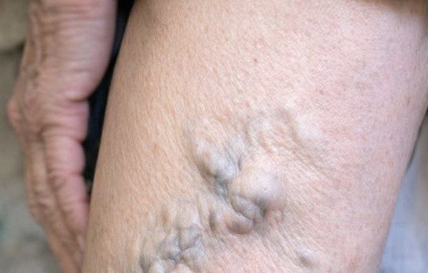 My mom showed me her legs today and the veins look like they are about to burst. She’s in pain but refuses to go to the ER. How can I help her at home?