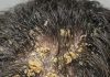 My husband’s head is covered in these thick, greasy yellow flakes and he can’t stop scratching. He is so embarrassed to go to work like this and we can’t get in to see a dermatologist for weeks.