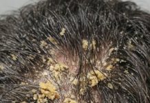 My husband’s head is covered in these thick, greasy yellow flakes and he can’t stop scratching. He is so embarrassed to go to work like this and we can’t get in to see a dermatologist for weeks.