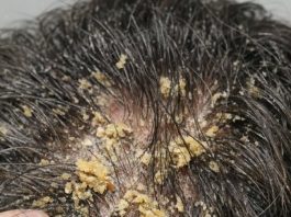 My husband’s head is covered in these thick, greasy yellow flakes and he can’t stop scratching. He is so embarrassed to go to work like this and we can’t get in to see a dermatologist for weeks.