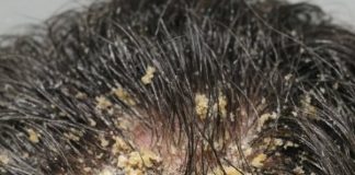 My husband’s head is covered in these thick, greasy yellow flakes and he can’t stop scratching. He is so embarrassed to go to work like this and we can’t get in to see a dermatologist for weeks.