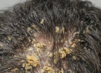 My husband’s head is covered in these thick, greasy yellow flakes and he can’t stop scratching. He is so embarrassed to go to work like this and we can’t get in to see a dermatologist for weeks.