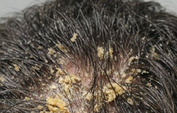 My husband’s head is covered in these thick, greasy yellow flakes and he can’t stop scratching. He is so embarrassed to go to work like this and we can’t get in to see a dermatologist for weeks.