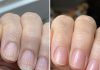 Soak your nails in this 1 mixture and get rid of brittle ridges, vertical lines, and flaky layers