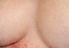 Apply this 1 mixture on your under chest area and get rid of red sweat rashes, painful chafing, and irritation.