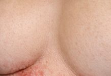 Apply this 1 mixture on your under chest area and get rid of red sweat rashes, painful chafing, and irritation.