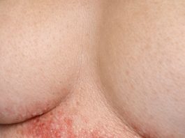 Apply this 1 mixture on your under chest area and get rid of red sweat rashes, painful chafing, and irritation.