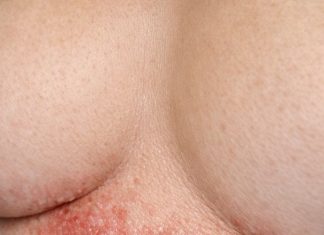 Apply this 1 mixture on your under chest area and get rid of red sweat rashes, painful chafing, and irritation.