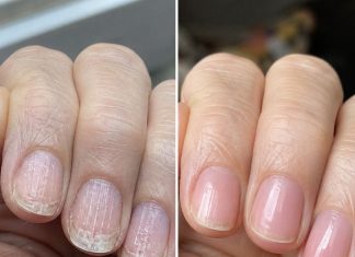 Soak your nails in this 1 mixture and get rid of brittle ridges, vertical lines, and flaky layers