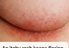 An itchy rash keeps flaring up under my breasts in winter, but my doctor isn’t available right now. What can I do today?