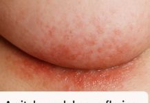 An itchy rash keeps flaring up under my breasts in winter, but my doctor isn’t available right now. What can I do today?