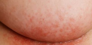 An itchy rash keeps flaring up under my breasts in winter, but my doctor isn’t available right now. What can I do today?