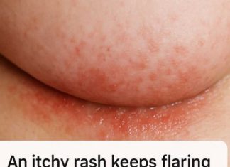 An itchy rash keeps flaring up under my breasts in winter, but my doctor isn’t available right now. What can I do today?