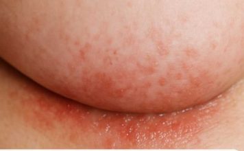 An itchy rash keeps flaring up under my breasts in winter, but my doctor isn’t available right now. What can I do today?
