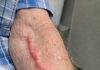 My grandfather woke up with this swollen red cord like vein on his arm. It is tender and warm but the urgent care is closed until tomorrow. Should we go to the ER?