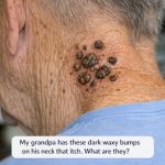 My grandpa has these dark waxy bumps on his neck that itch. What are they?