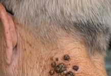 My grandpa has these dark waxy bumps on his neck that itch. What are they?